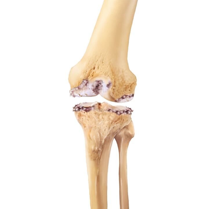 destruction de l'articulation du genou avec arthrose