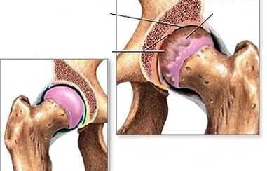 Diagnostic d'arthrose de la hanche