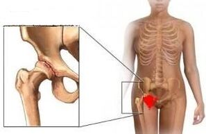 Les raisons du développement de l'arthrose de l'articulation de la hanche