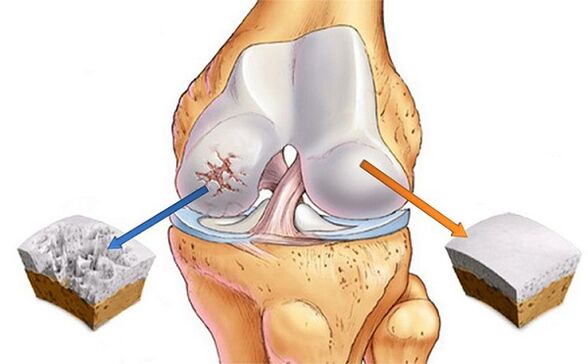 Norme et écart pour l'arthrose de l'articulation du genou