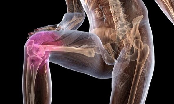 Signes et symptômes de l'arthrose de l'articulation du genou
