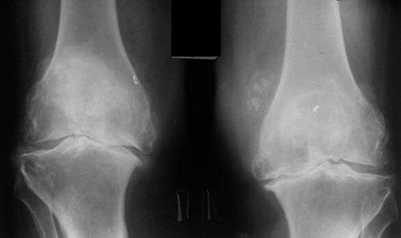 X-Ray comme moyen de diagnostiquer l'arthrose de l'articulation du genou