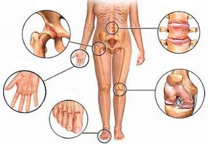 Arthrite et arthrose de plusieurs articulations