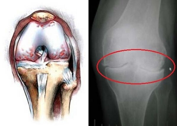 La déformation de l'articulation du genou pour l'arthrose