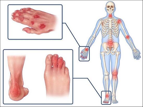 Rougeur de la peau et gonflement des articulations avec arthrite