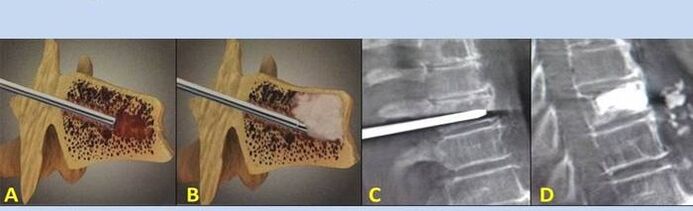 vertébroplastie par ponction pour les maux de dos