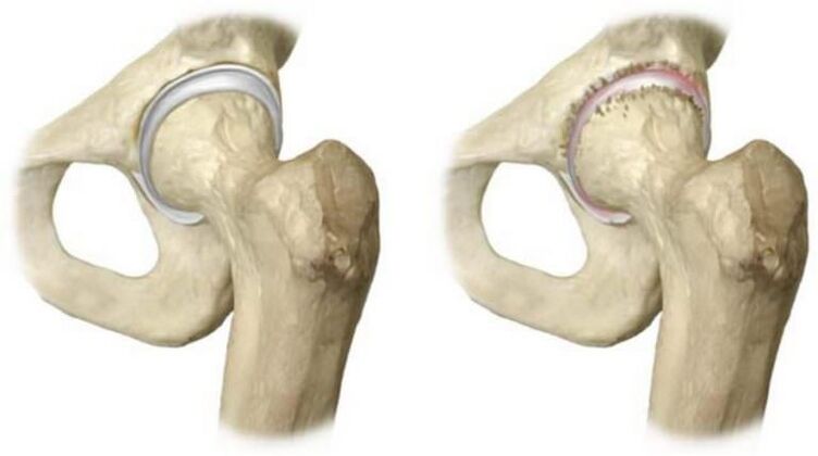nécrose de l'articulation de la hanche et de la tête en bonne santé comme cause de douleur