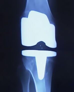 Radiographie d'un genou avec une prothèse artificielle après une arthroplastie