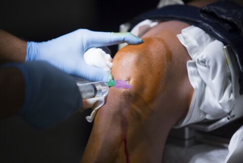 Injections dans l'articulation du genou pour l'arthrose. 